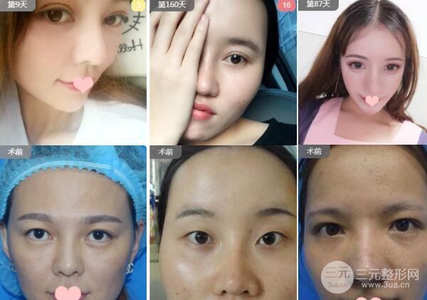 温州附一医整形科双眼皮案例