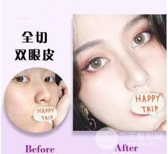 武汉人民医院整形美容科双眼皮案例