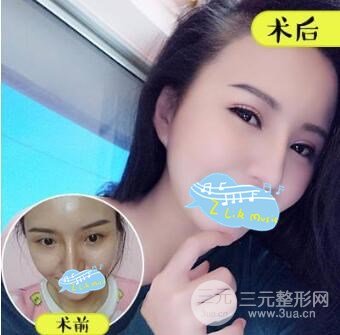 川北医学院附属医院整形美容科向小燕医生双眼皮案例