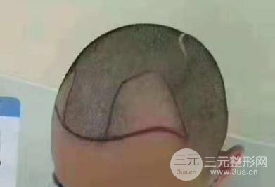成都碧莲盛男性植发案例