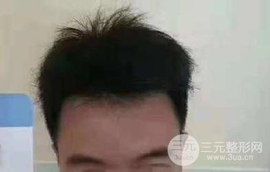 成都碧莲盛男性植发案例