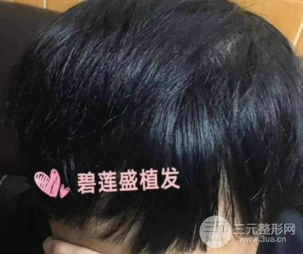 成都碧莲疤痕植发案例