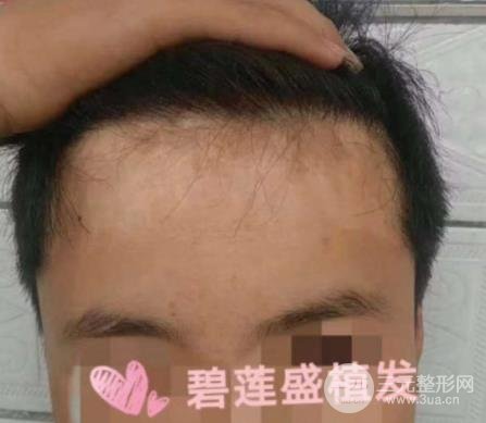 成都碧莲盛疤痕植发案例