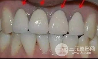 烤瓷牙果