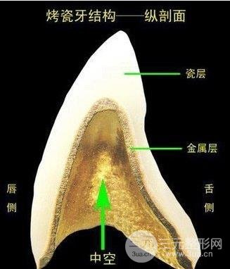 烤瓷牙种类