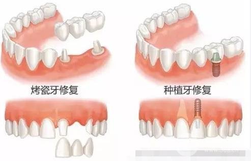 上海烤瓷牙价格表2025