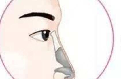 上海鼻王王会勇案例