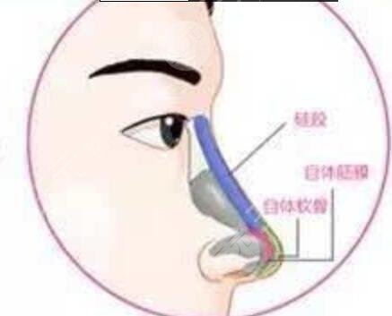 广州韩妃沈绍勇鼻子修复案例