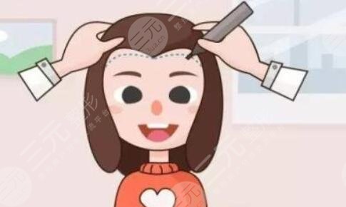 上海九院吴巍植发案例