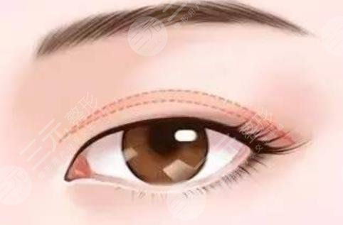 双眼皮