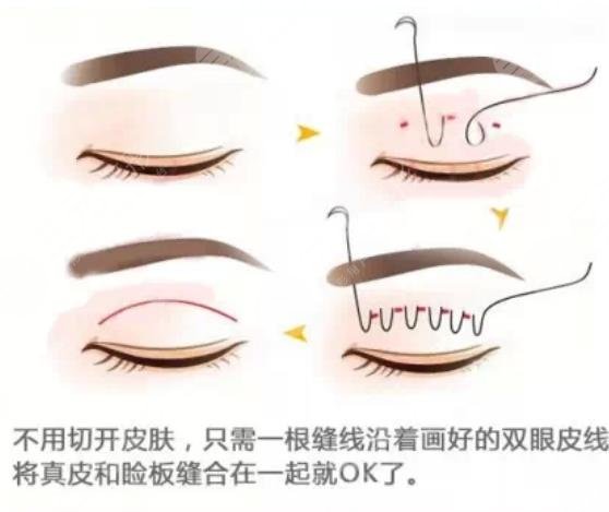 埋线双眼皮