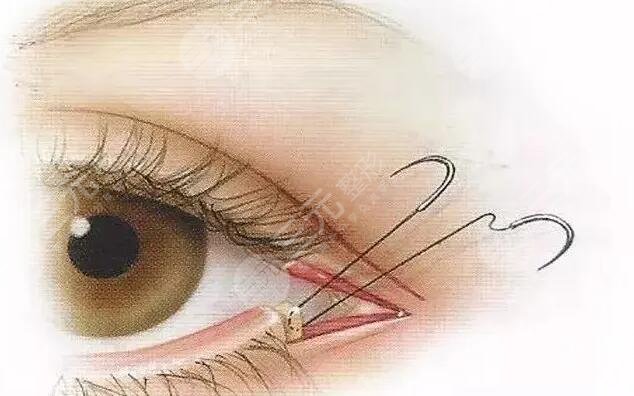 开完外眼角后的图片对外公布,网红小姐姐展示恢复过程,看完都惊呼"想