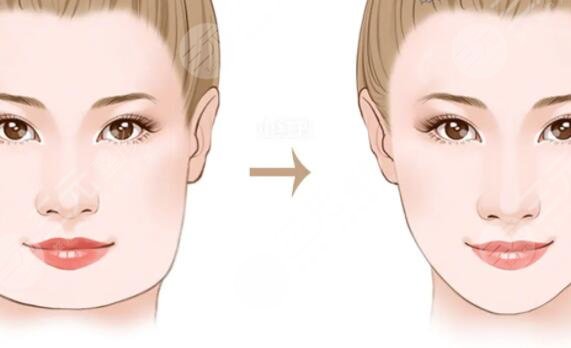 磨骨手术对比照片真实效果查看：术后妥妥鹅蛋脸！阳光总在风雨后~
