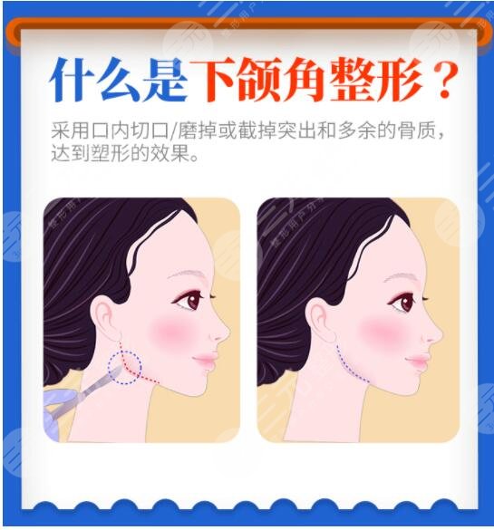 削骨三年后的真实案例反馈：终于拥有梦幻般鹅蛋脸！高资质医生杰作！