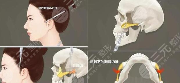 削骨手术的过程是怎样的？