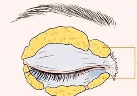 双眼皮