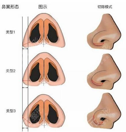 上海九院闵沛如隆鼻手术案例图