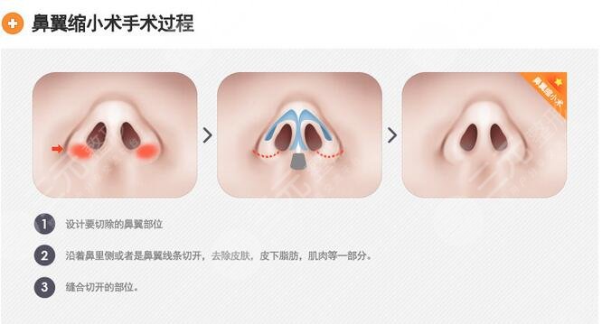 上海九院闵沛如隆鼻手术案例图