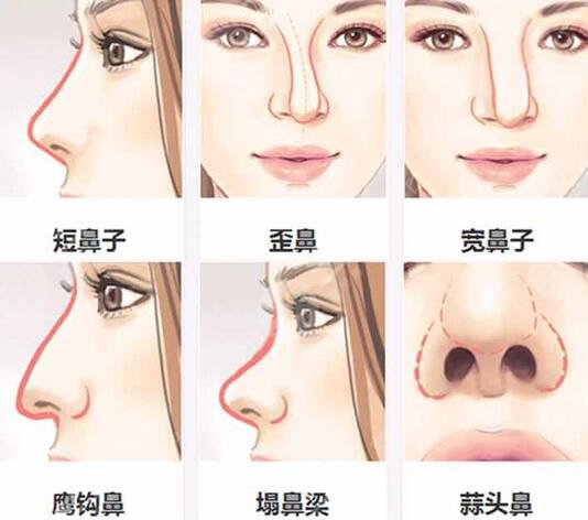 上海九院闵沛如隆鼻手术案例图