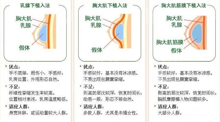 穆大力隆胸收费