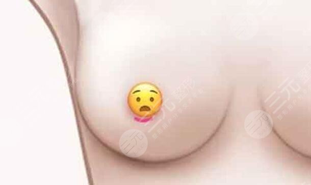 棉花糖假体隆胸术前