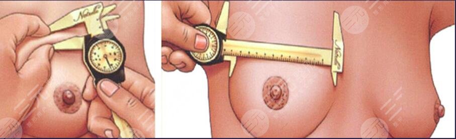 棉花糖假体隆胸术后1个半月