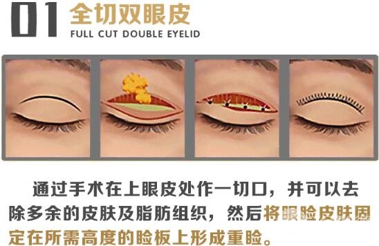 全切双眼皮