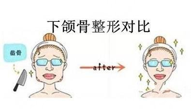卢丙仑做过下颌角案例