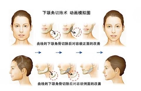 卢丙仑做过下颌角案例