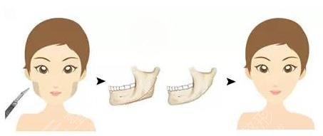 河东镐截下颌角案例果