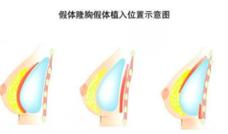 水滴型隆胸躺下后果