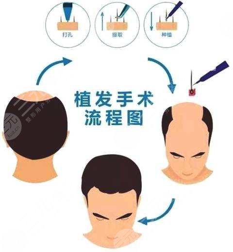 深圳北大医院植发案例效果图(网友亲身经历):术前