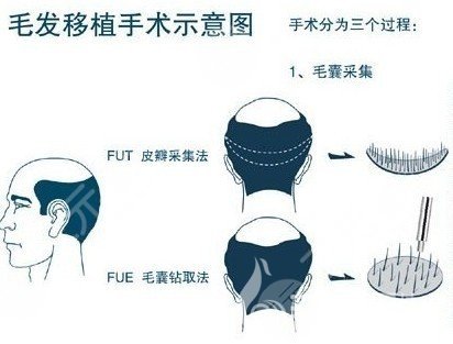 深圳北大医院植发案例效果图(网友亲身经历)