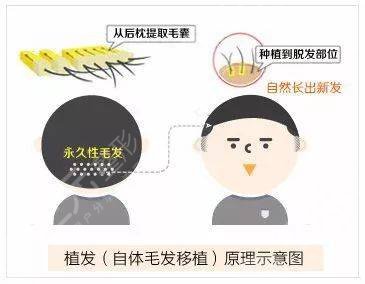 植发技术介绍
