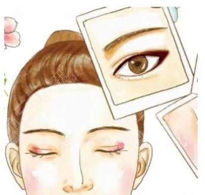 齐云香案例双眼皮术后效果