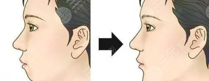凸嘴矫正