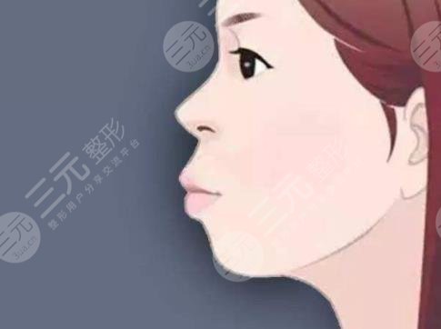 凸嘴矫正