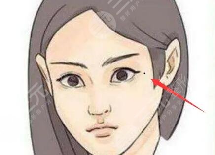 色素痣