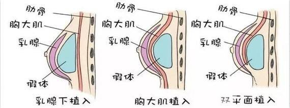 做完隆胸手术后多久可以侧着睡?
