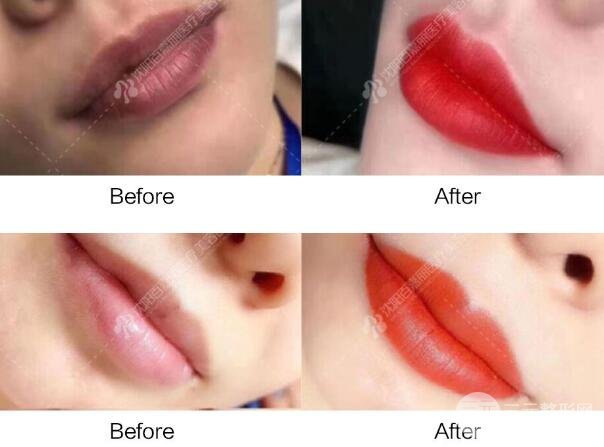 纹唇必须留意什么事儿