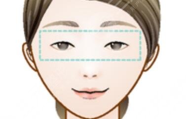 美瞳线一到七天恢复过程图：没做之前