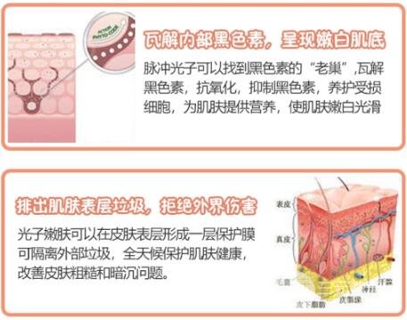 南通大学附属医院光子嫩肤项目讲解