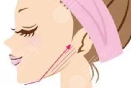 rd素注射瘦脸案例图