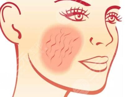 南方激光美容医院激光祛斑案例