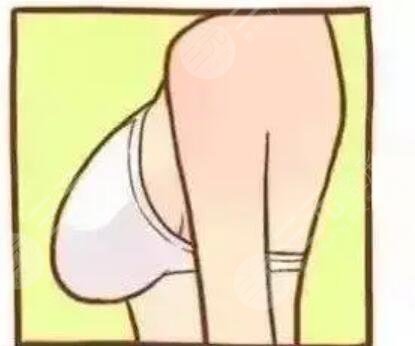 栾杰自体脂肪丰胸案例 做女人“挺”好~