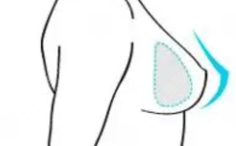 栾杰自体脂肪丰胸案例 做女人“挺”好~