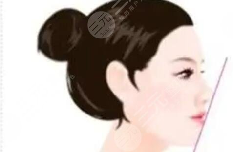 曹海峰医生隆鼻术前术后对比照