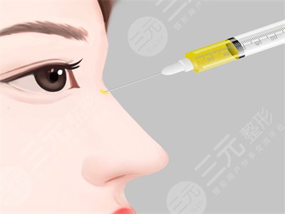深圳北大李天石做鼻子怎么样 本人亲身隆鼻案例~