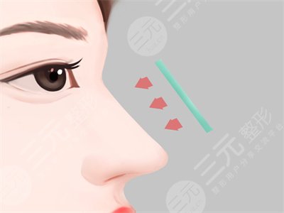 深圳北大李天石做鼻子怎么样 本人亲身隆鼻案例~