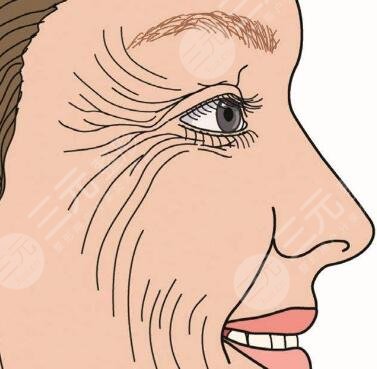 毕洪森内窥镜除皱案例 术后真的年轻好几岁了